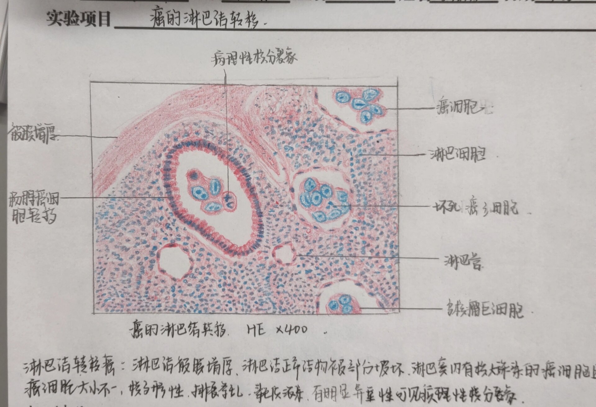 癌的淋巴结转移红蓝铅笔