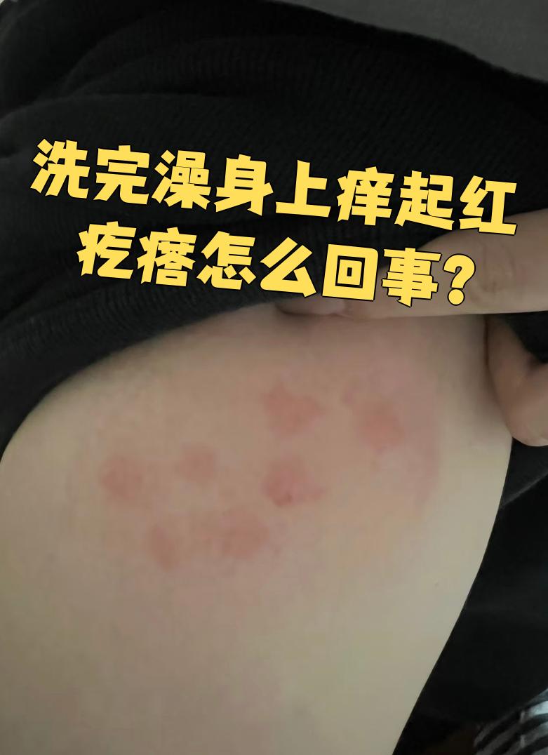 为什么身上起疙瘩还痒