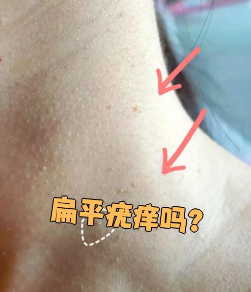 扁平疣痒吗?