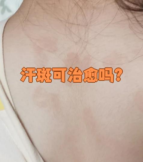 汗斑是可以治愈的