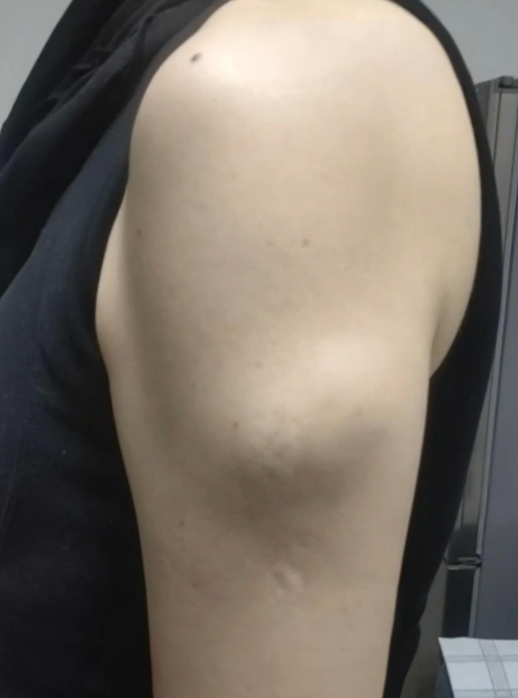 手臂出现结节硬块常见原因包括外伤,毛囊炎,脂肪瘤,皮脂腺囊肿和