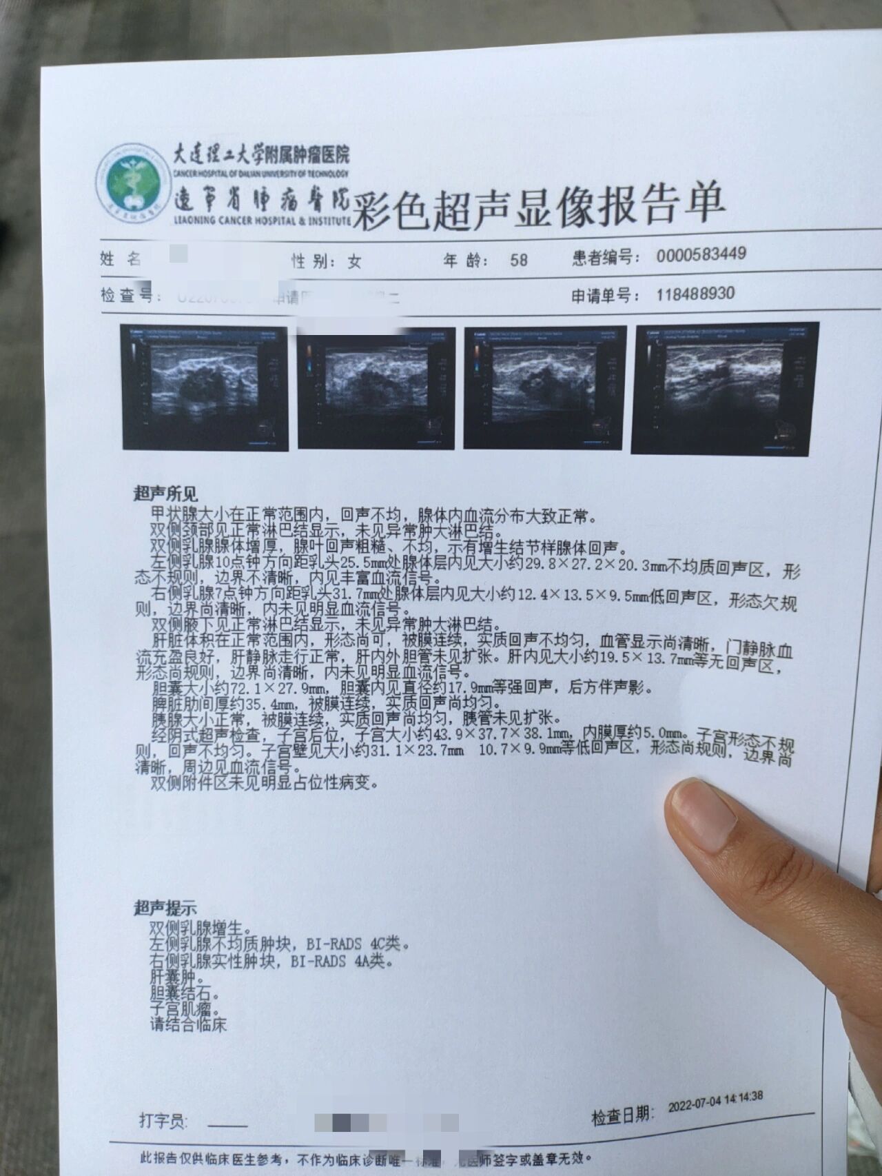 乳腺结节4c图片