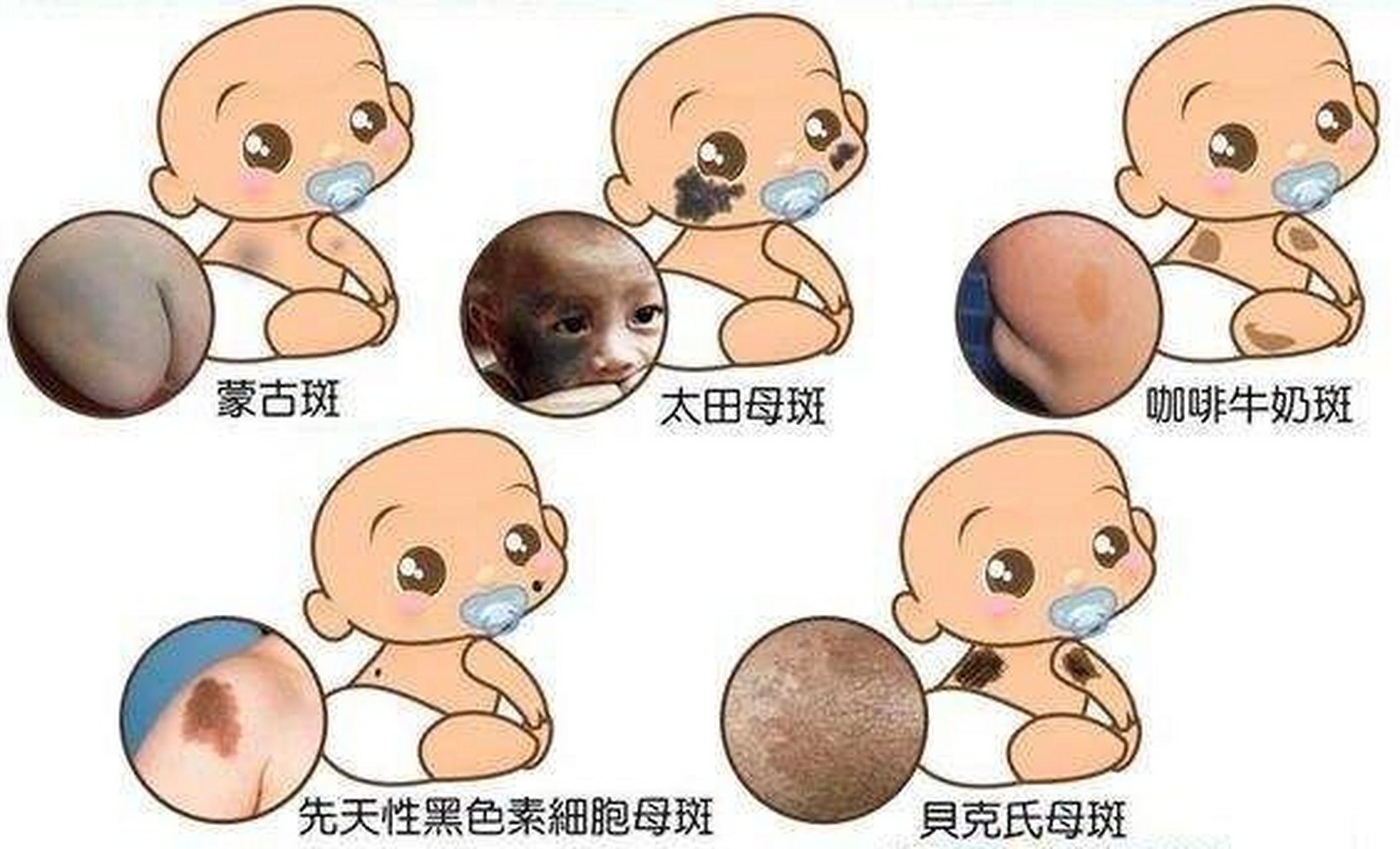 宝宝常见胎记;宝妈宝爸收藏一下!