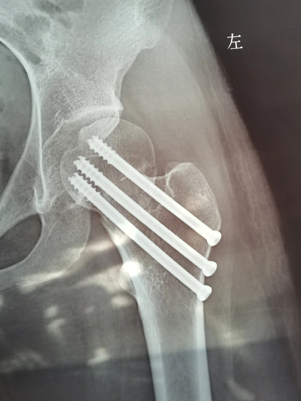 股骨粗隆间骨折内固定图片