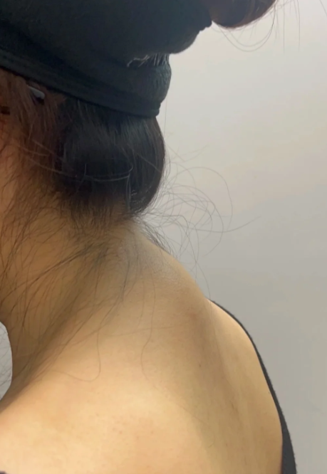低头时脖子后面骨头突出,最常见的是颈椎棘突,这是正常结构
