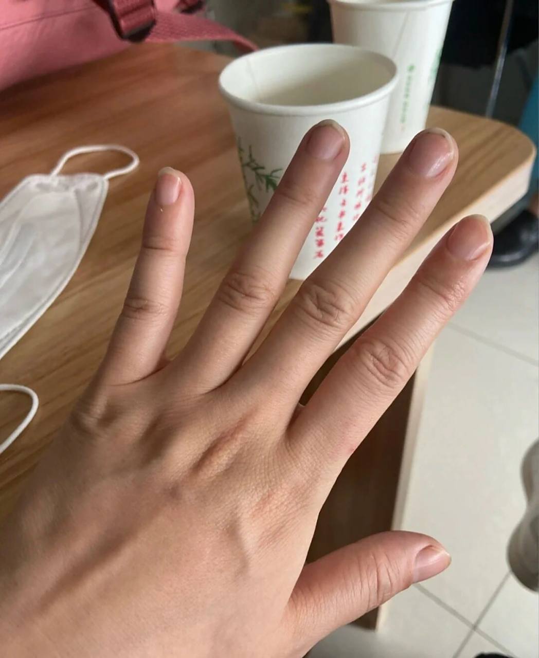 类风湿真的让手指又肿有痛啊 风湿关节炎让我的手指又肿又痛,心情烦躁