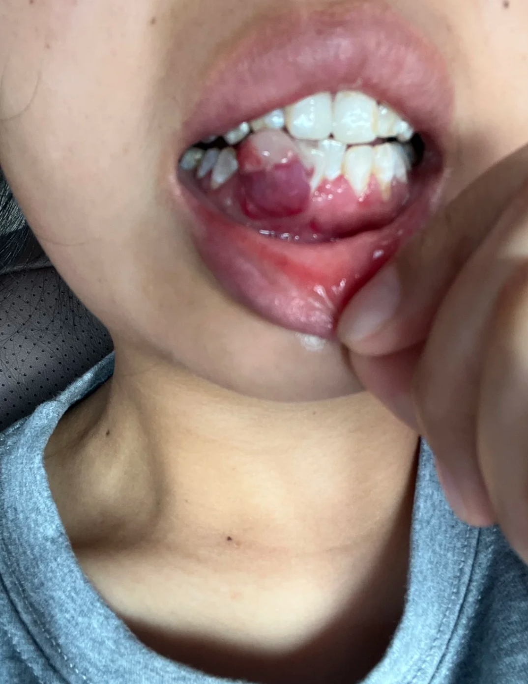 牙齿中间空了个大洞还冒出一块肉,最常见的是牙龈息肉,但也可能是