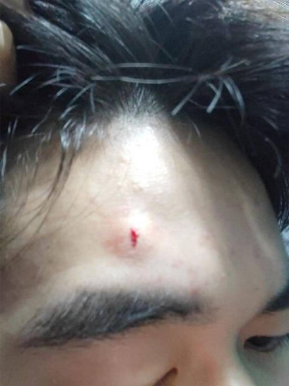 【男生睡觉误拽掉充电器额头被砸伤:当时一下被砸清醒,人都懵了】9月