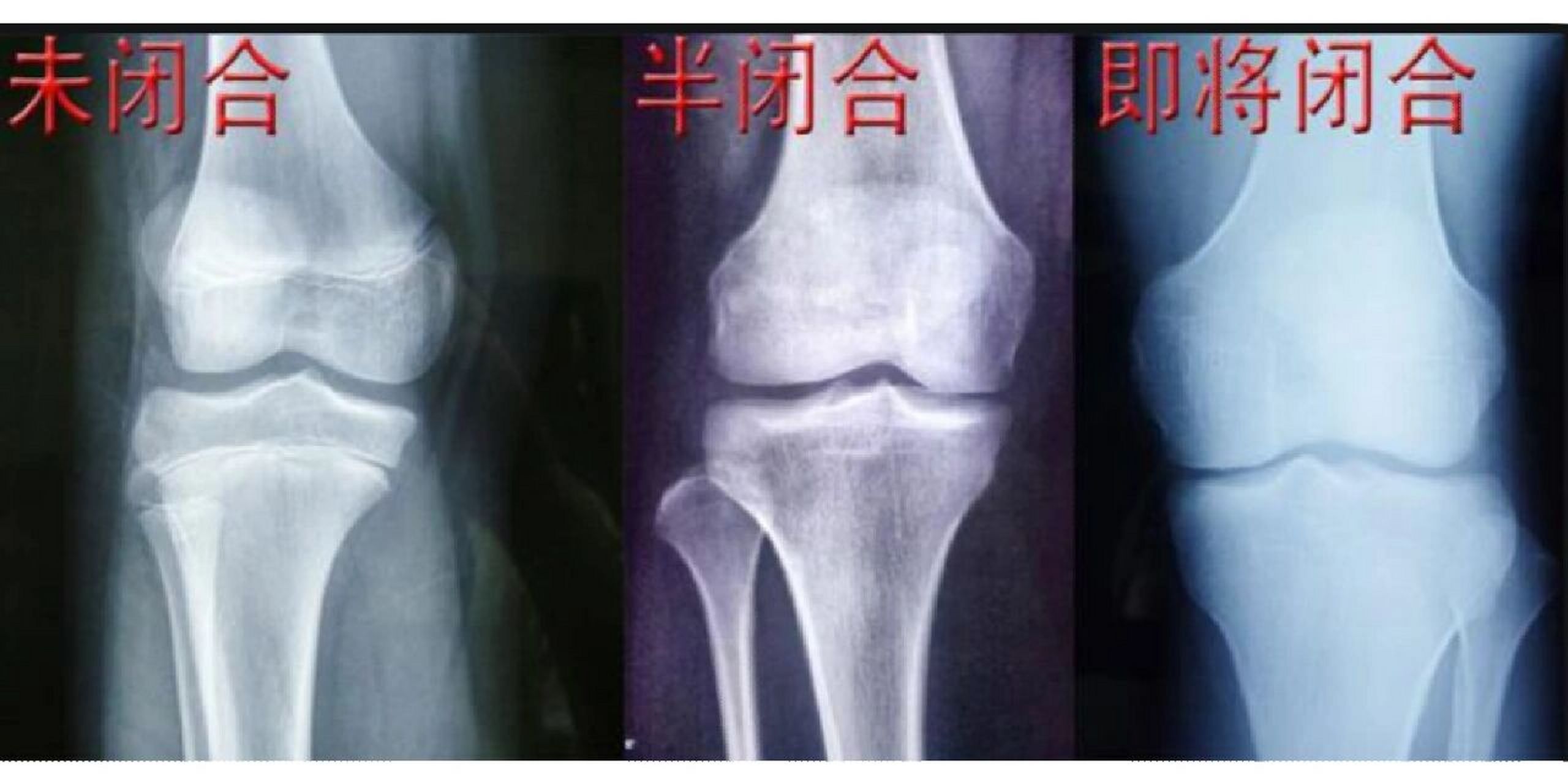 到底怎么样才算是骨骺线真正的闭合吗?