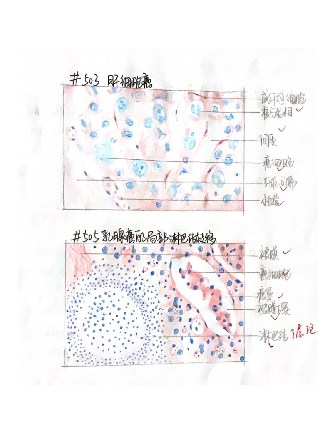 鳞状细胞癌绘图图片