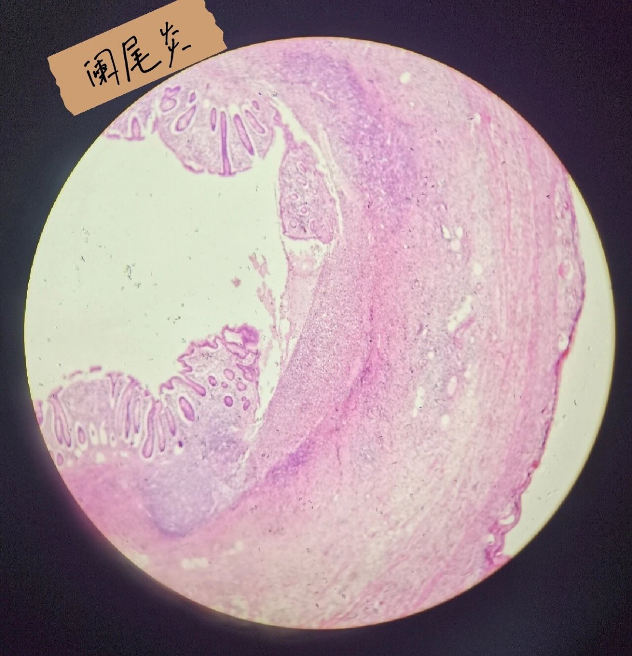 切片-急性阑尾炎 急性阑尾炎 诊断描述:低倍镜下,可见阑尾各层组织