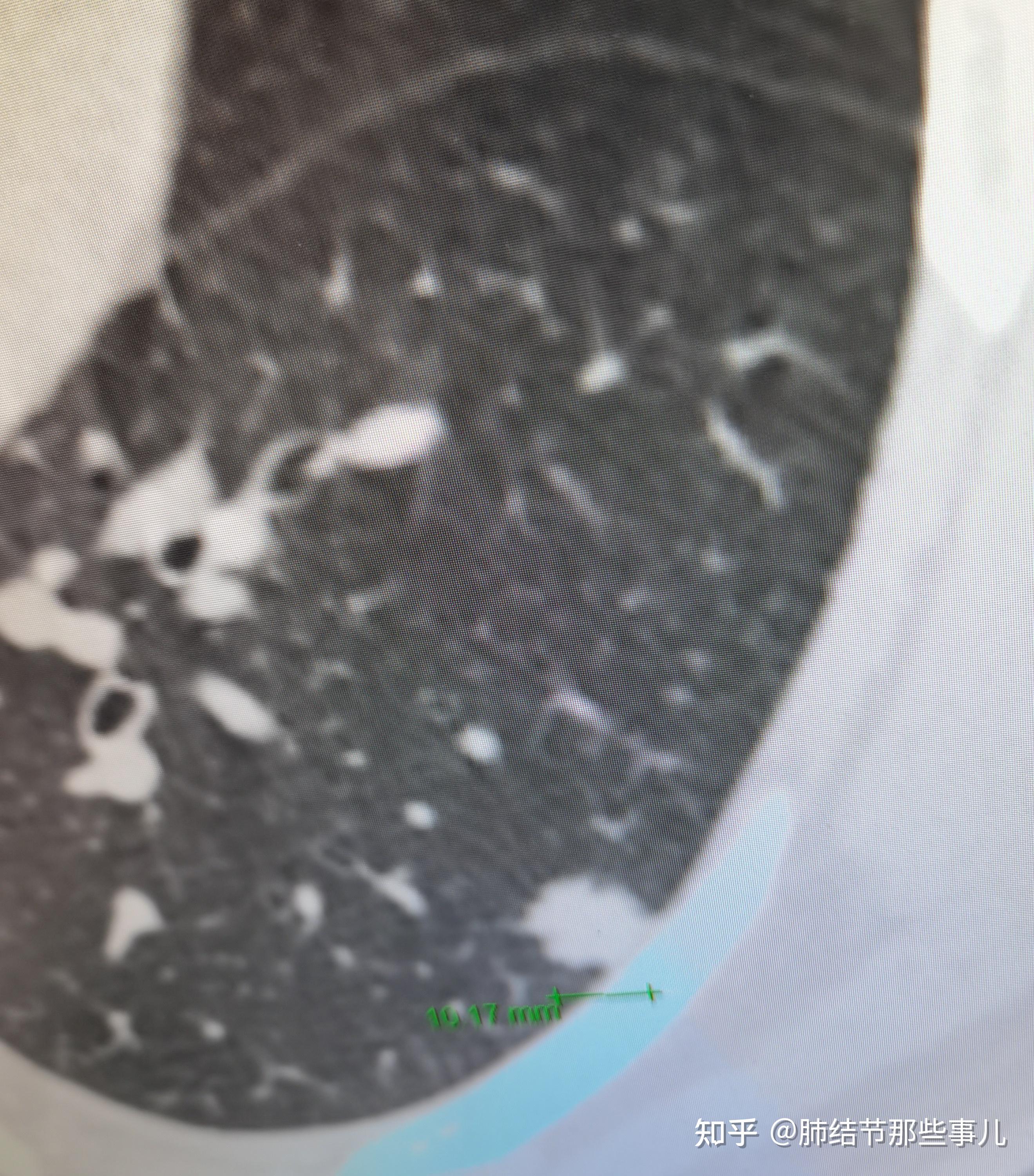 恶之花黏液腺癌一例30岁年青男性的10mm肺实性结节