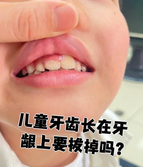 孩子牙齿长在牙龈上,先要弄清楚是乳牙,恒牙还是多生牙