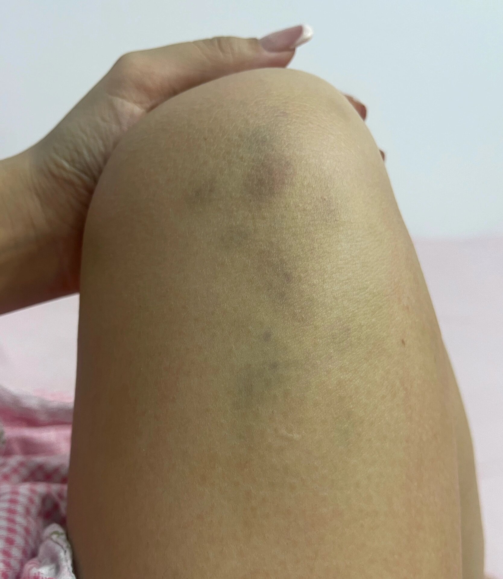 有没有莫名其妙腿淤青的?