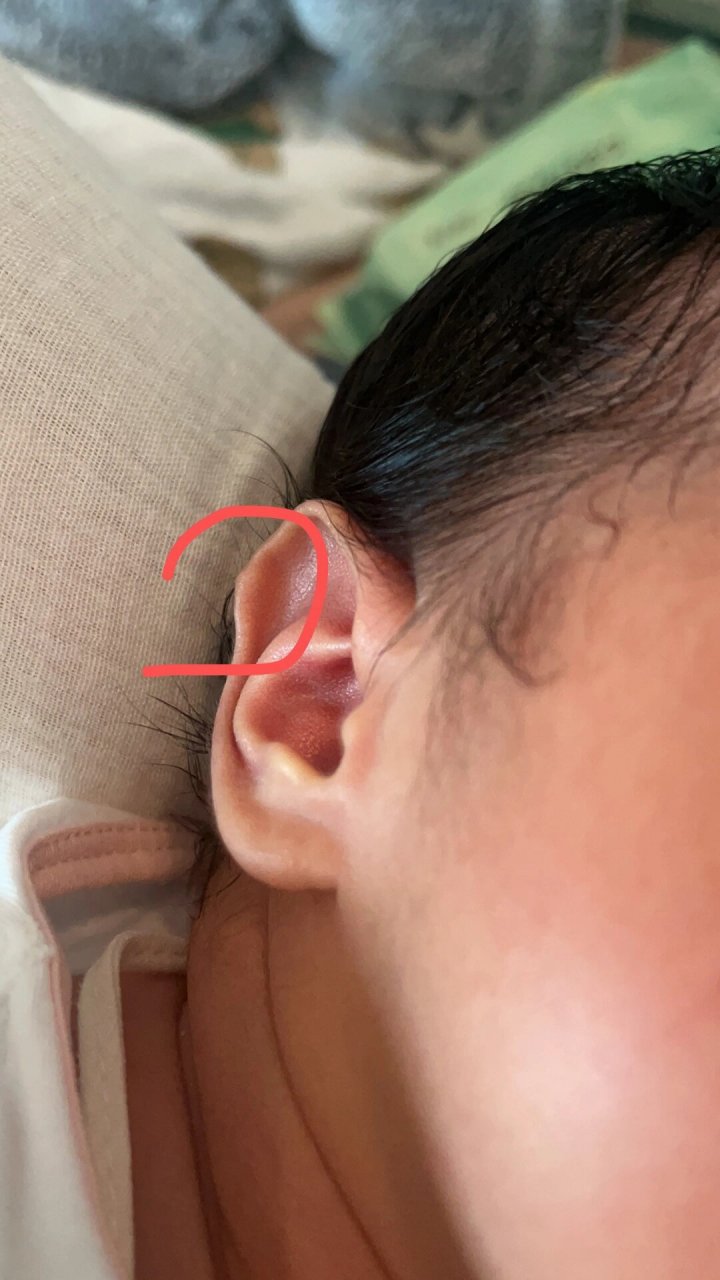 新生儿耳朵👂,怎么回事?