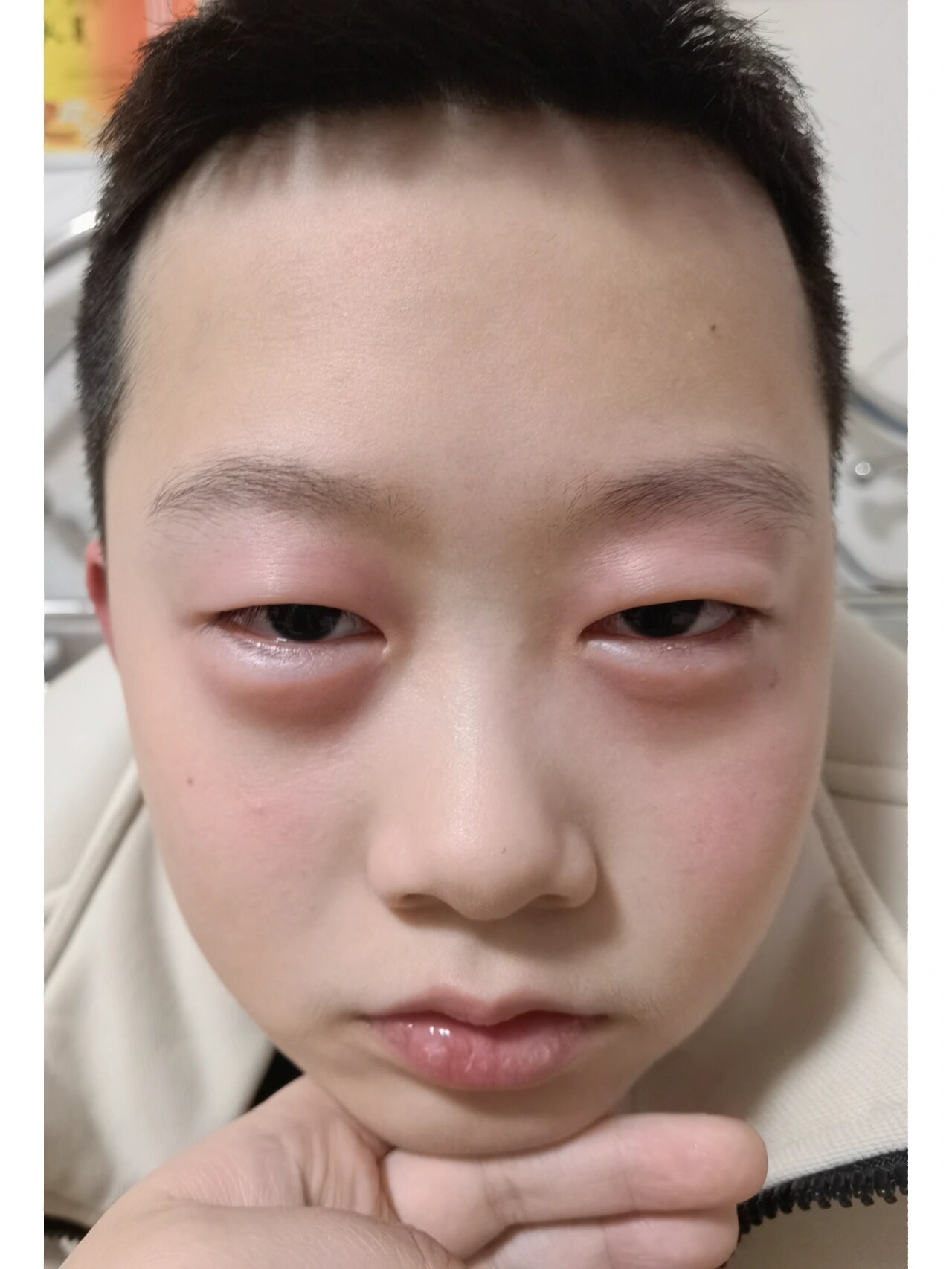 儿子老是眼睛上长疙瘩,还痒,像是过敏的症状,但为什么老是过敏在眼睛