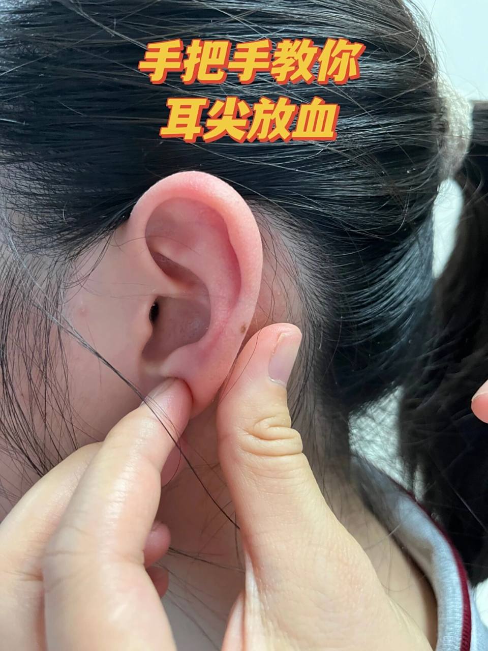 麦粒肿消散的法宝——耳尖放血! 麦粒肿也是眼科最常见的病之一.