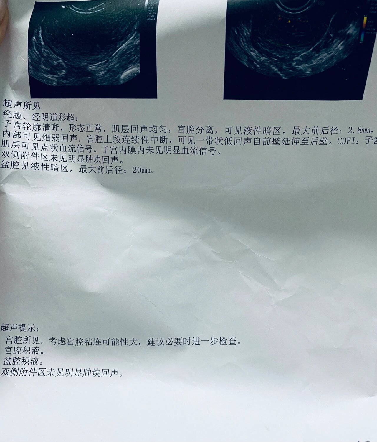 宫腔粘连突然怀孕了?