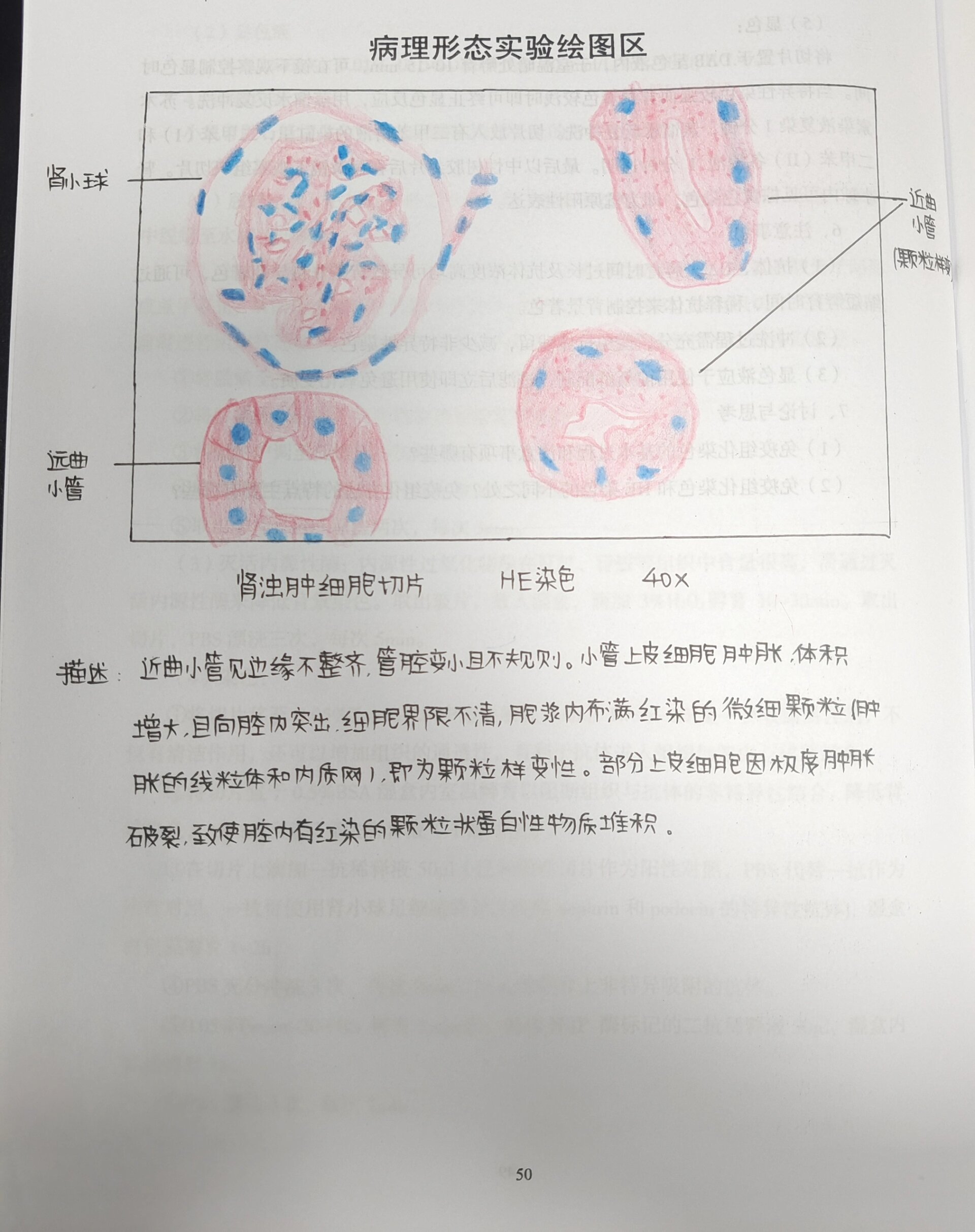 病理学绘图 肾浊肿细胞切片红蓝铅笔绘图 获得了a