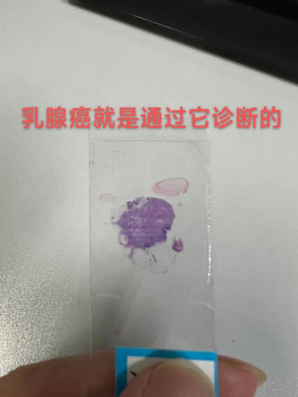 乳腺癌病理切片图片