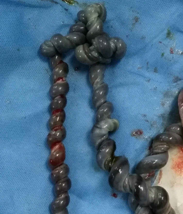 脐带扭转的量化指标:脐带螺旋指数 很多准妈分不清脐带扭转和脐带缠绕