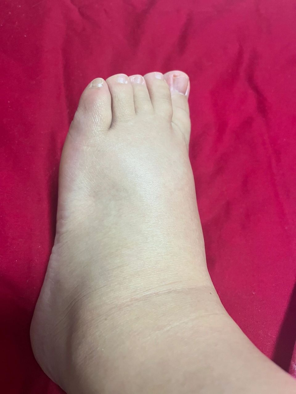 孕五个月,脚肿了 有怀孕五个月脚肿的姐妹嘛, 要不要去医院检查一下