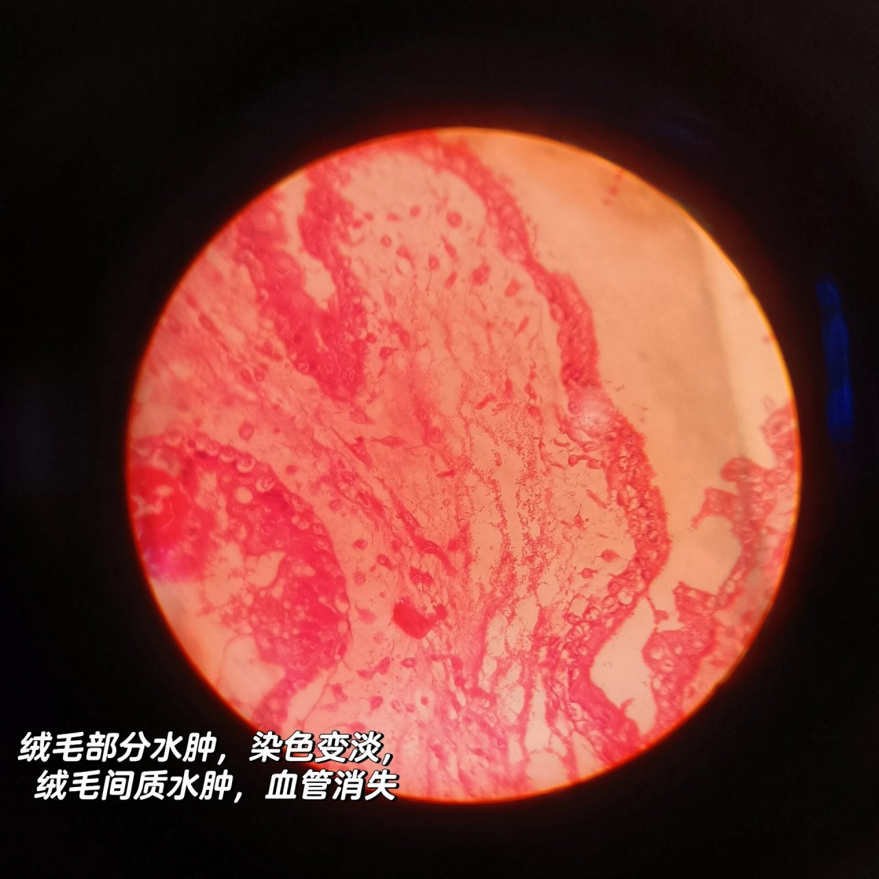 【病理切片复习】葡萄胎(自用) 诊断:葡萄胎 描述:(1)绒毛间质水肿