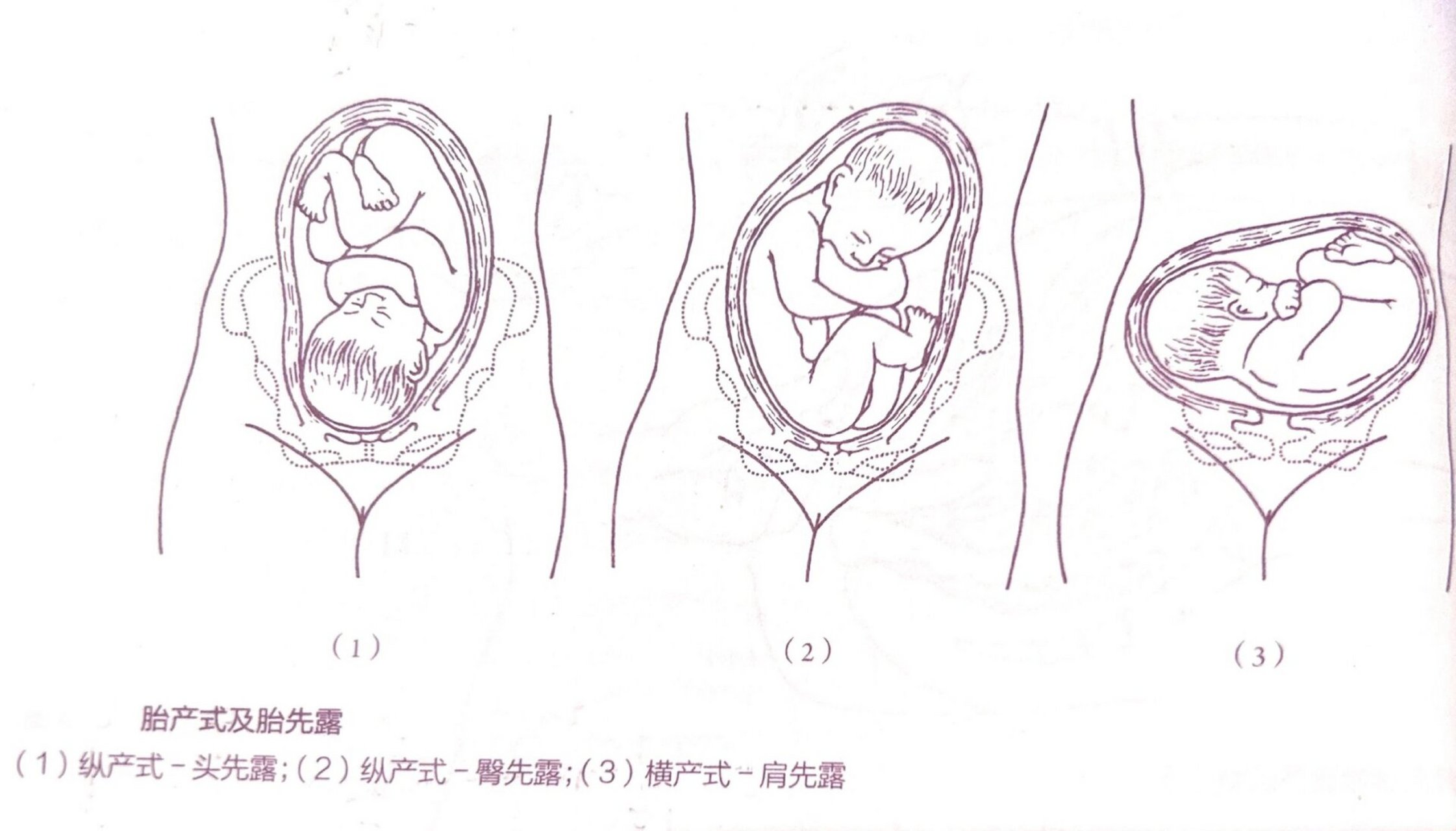 图15:胎产式和胎先露060292