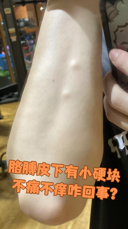 皮下出现不痛不痒的小硬块,常见原因有脂肪瘤,皮脂腺囊肿和炎症结节