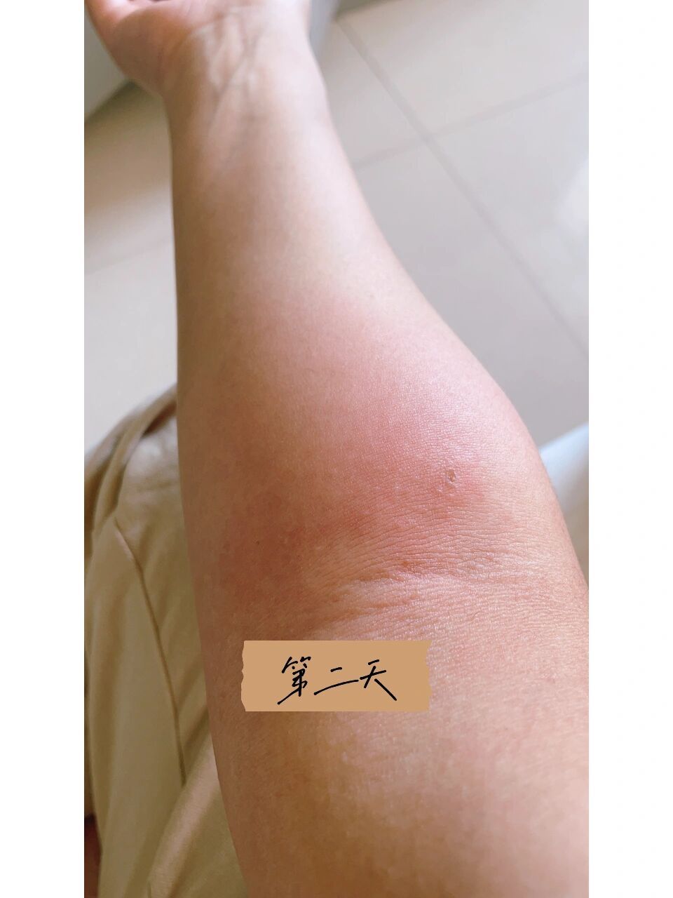 真实体验了一下93蜂蜇伤 被一只小蜜蜂蛰住了胳膊,第一反应赶紧把刺