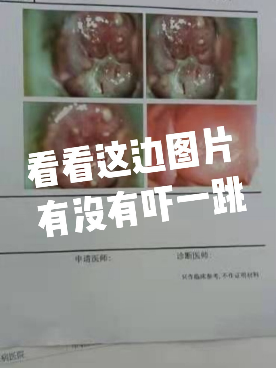 女性的健康不能忽视 这张图片很明显的宫颈纳囊 咋一看是不是吓到自己