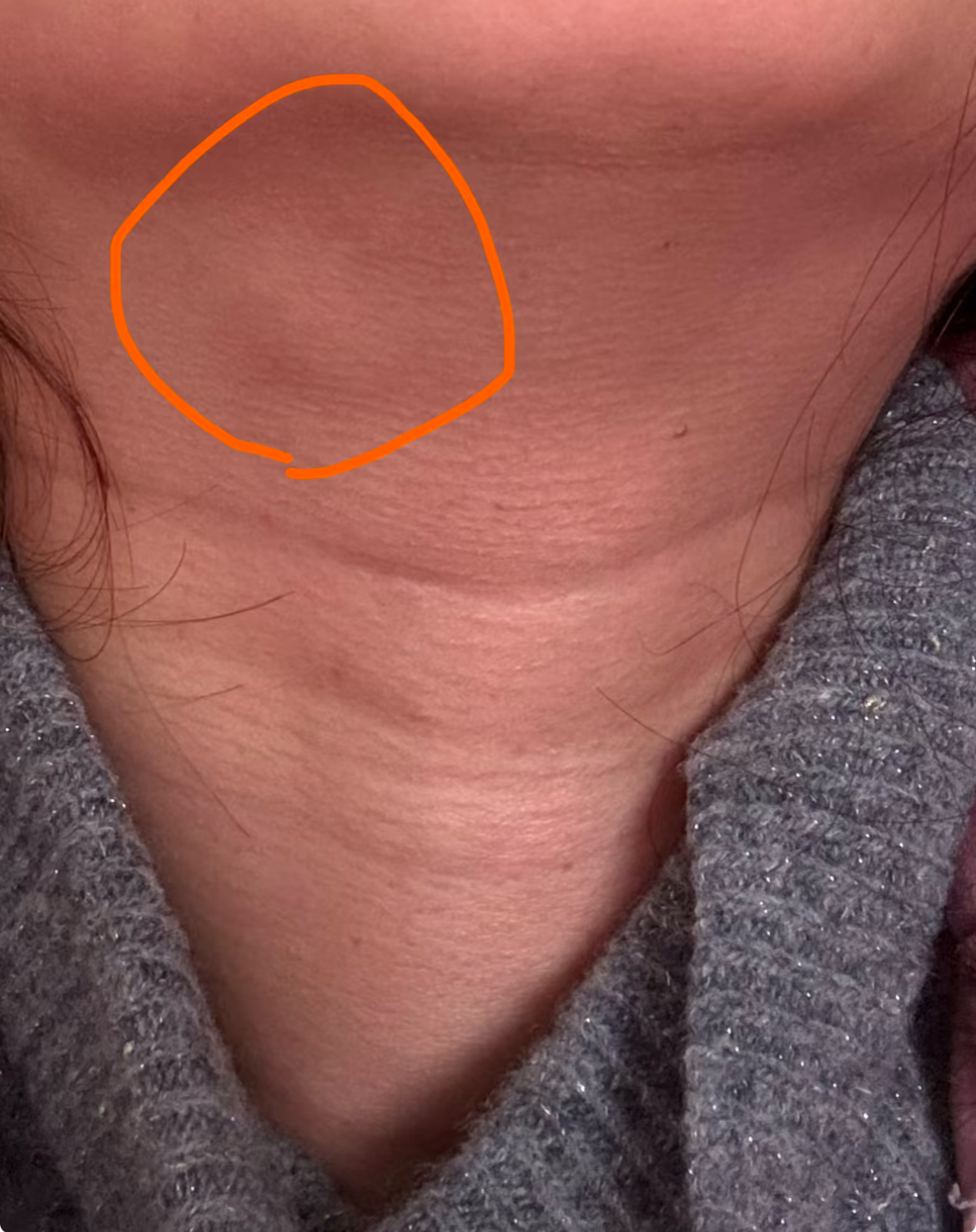 首先,考虑颌下淋巴结肿大,这通常由口腔感染,急性上呼吸道感染,秧喉