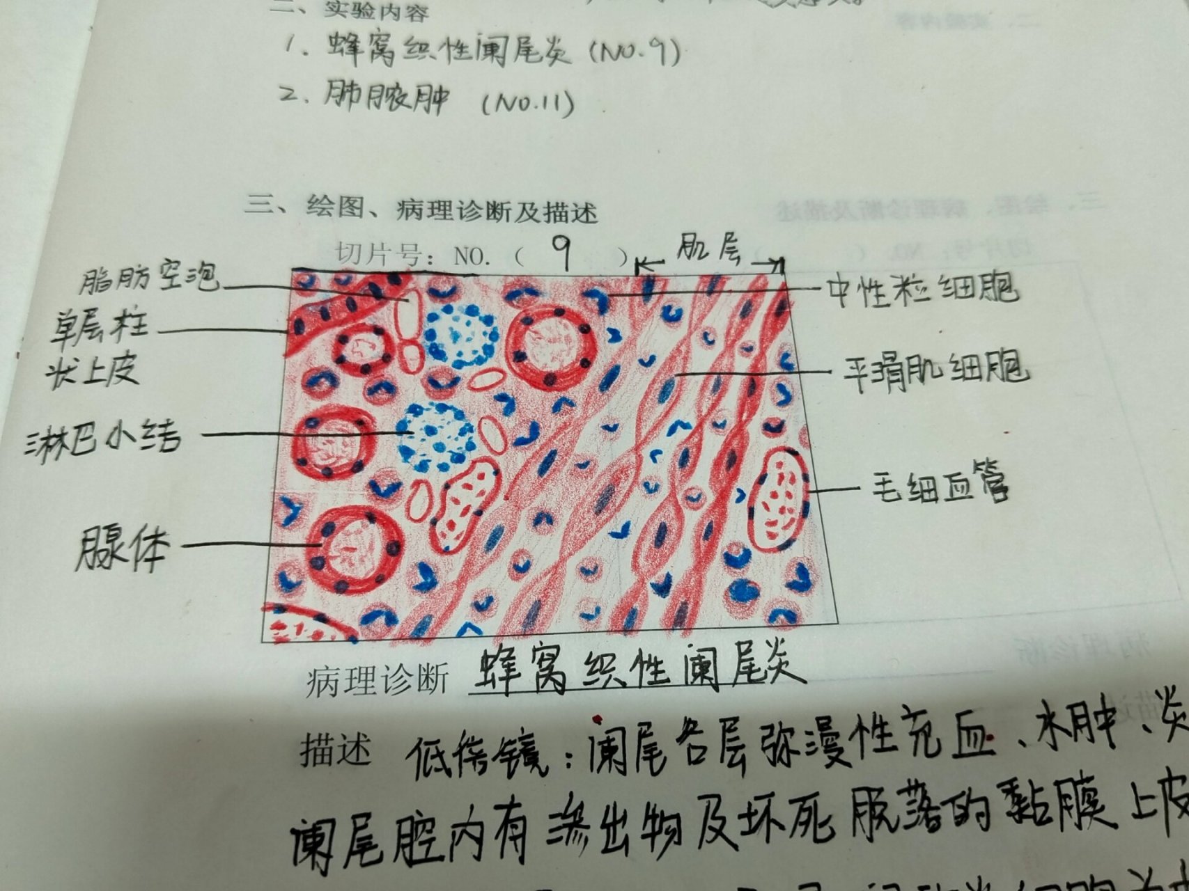 蜂窝织性阑尾炎