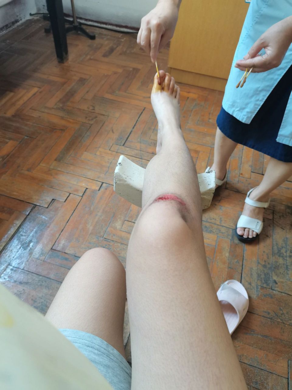 腿摔伤的照片真实女孩图片