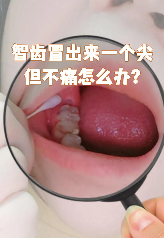 智齿冒出一个尖但不痛的话,一般可以先观察