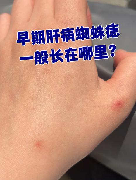 蜘蛛痣其实是皮肤小动脉末端分支