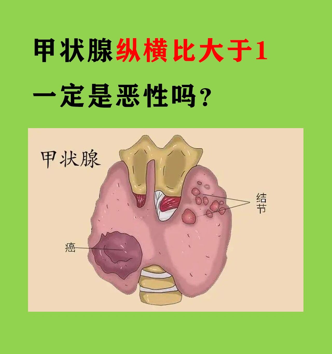 甲状腺纵横比大于1一定是恶性的吗?