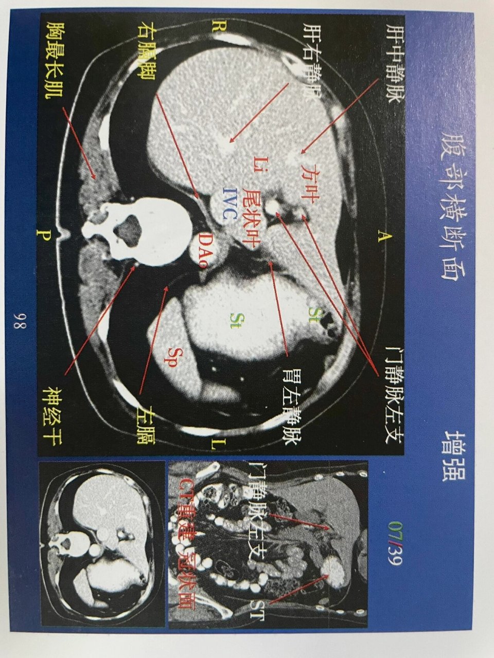 腹部第一组增强解剖!肝脏ct增强解剖!上腹部 肝脏详细横断面解剖图!