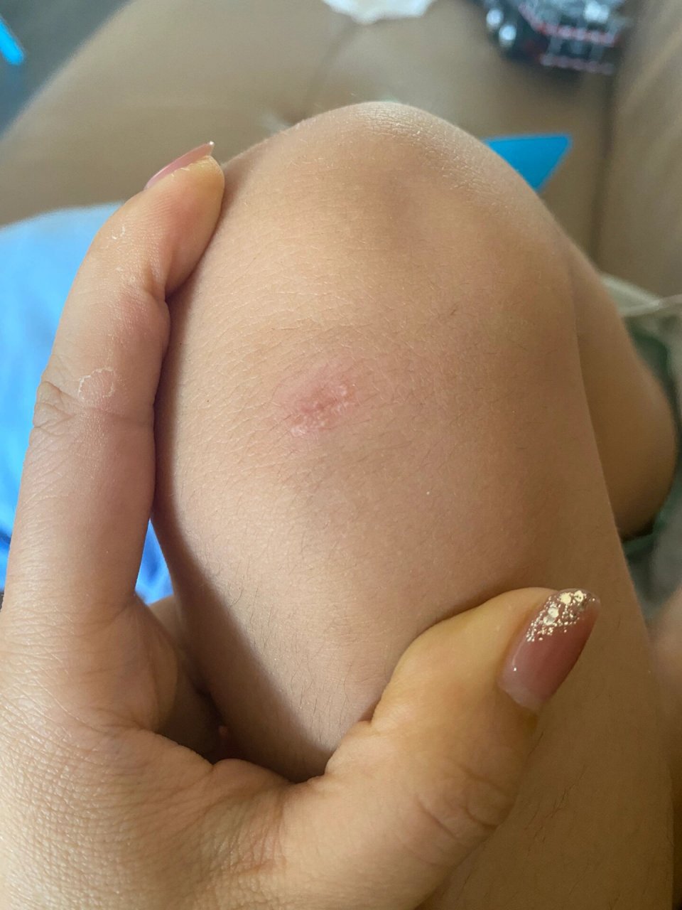 孩子膝盖磕破后伤口疤痕上长白色颗粒 孩子膝盖磕破两次,好咯以后伤口