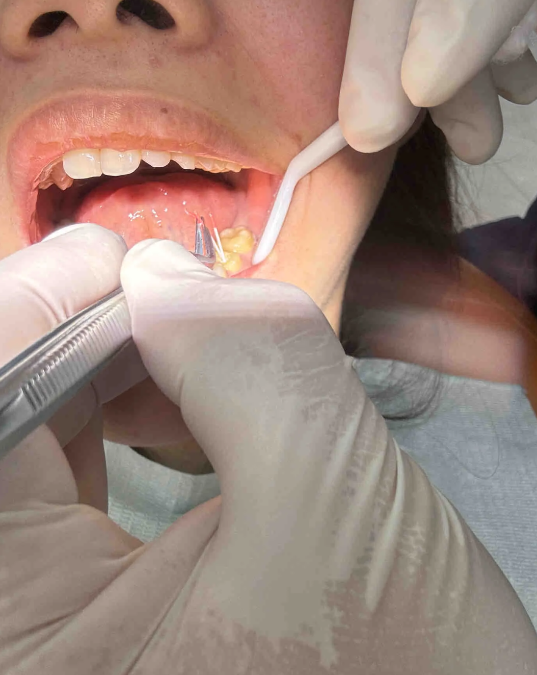 龋齿的治疗方法要根据龋坏程度来选择