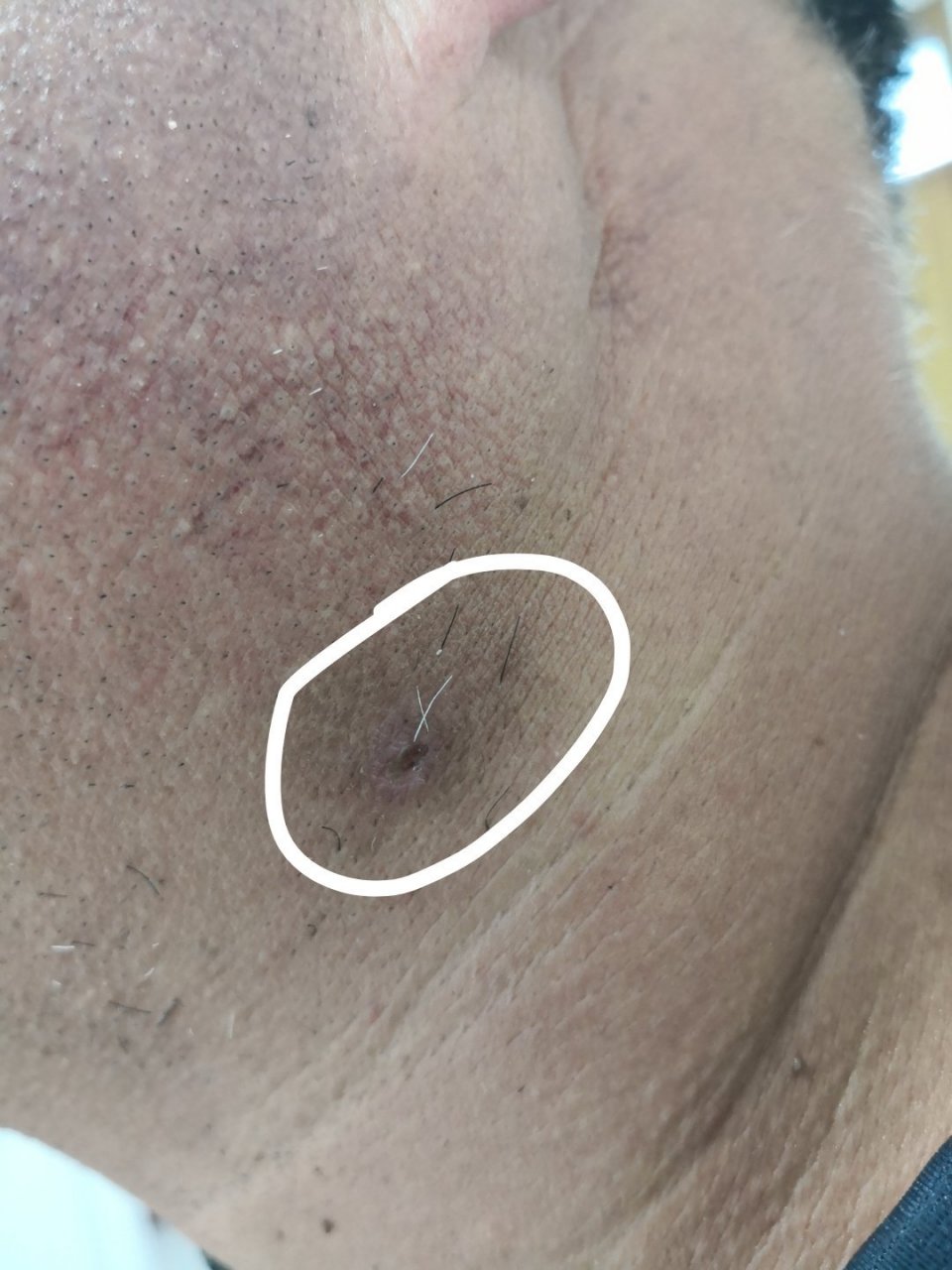 颈部寻常疣激光治疗去除后恢复期症状#皮肤##解决皮肤问题专注皮肤