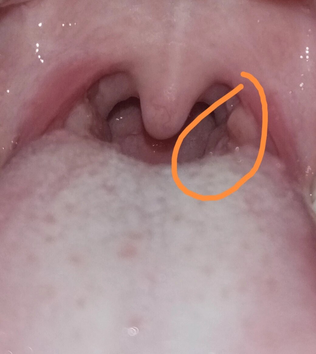 口腔里面长了不明的包(后面有附图.) 究竟是什么?