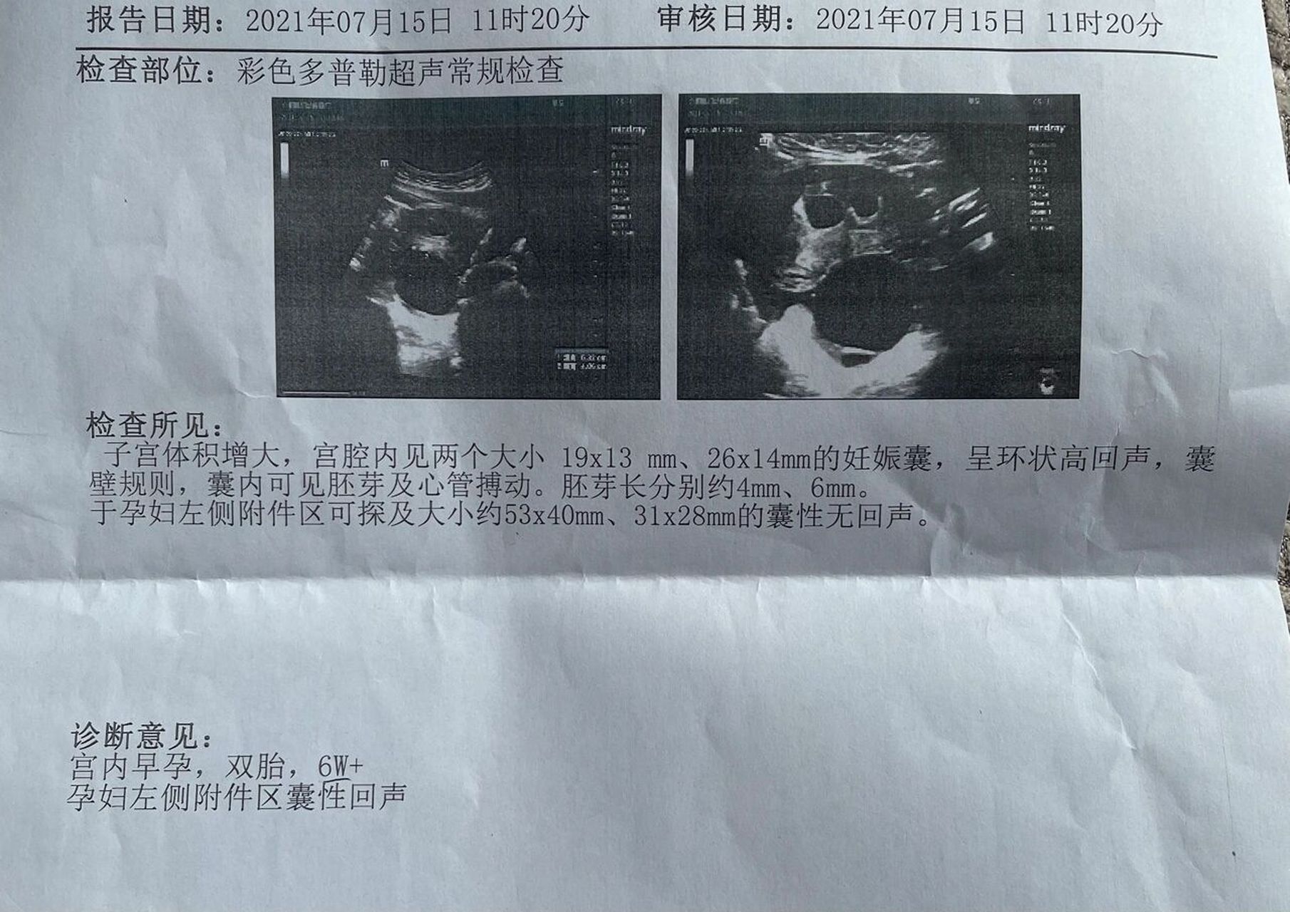 双胞胎? 我慌了,上一次做还是一个孕囊,这次变成两个了!