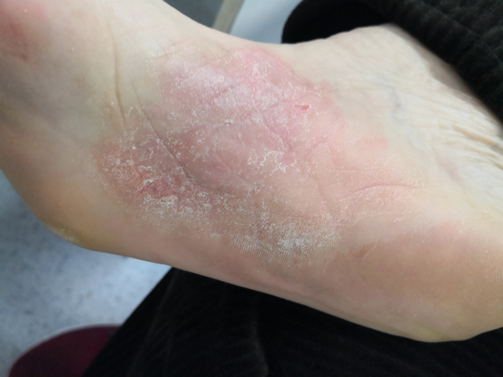 考虑角化型湿疹,要排查一下真菌感染引起的角化型足癣可能#足癣