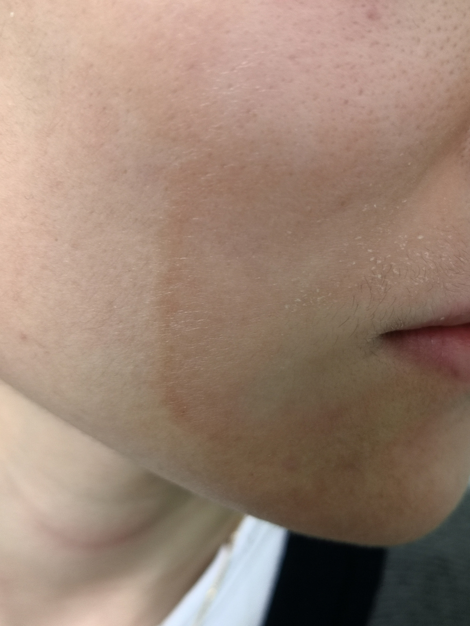 边界清楚要与面部真菌感染相鉴别#接触性皮炎##体癣