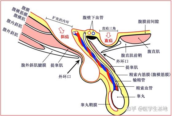 腹股沟斜疝和直疝图解图片