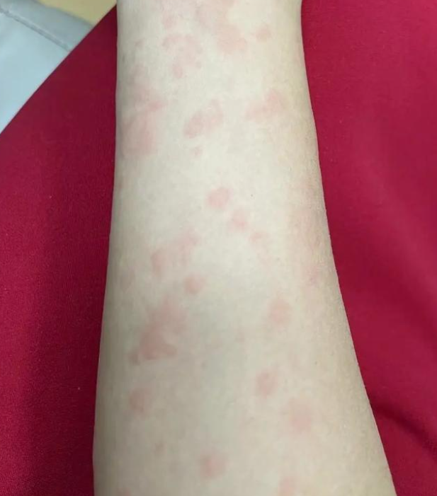 为什么晚上睡觉皮肤痒 为什么晚上睡觉皮肤痒