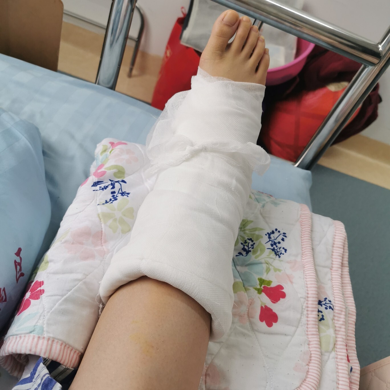打石膏怎么这么疼!骨折手术出院前的折磨