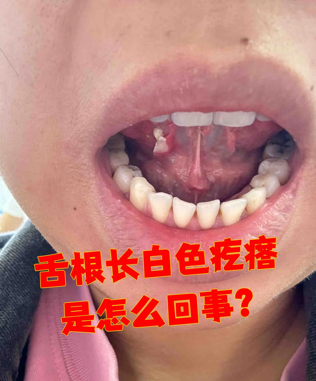 舌根长白色疙瘩可能是正常结构,也可能是急性扁桃体炎,慢性咽炎或