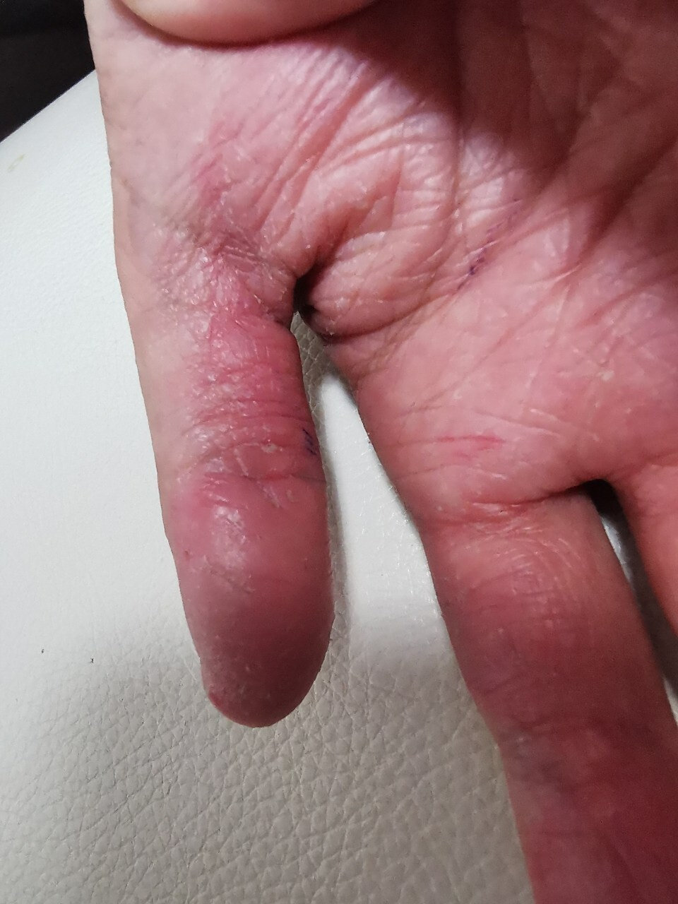 的手周期性的脱皮严重怎么办 孩子十岁,从三岁开始,手部季节性的蜕皮